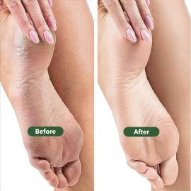 TADA Natural Beauty Foot File Callus Remover - Multi Purpose 2 in 1 Feet Pedicure Tools with Foot Scrubber, Pumice Stone TADA Natural Beauty Foot File Callus Remover - Multi Purpose 2 in 1 Feet Pedicure Tools with Foot Scrubber, Pumice Stone