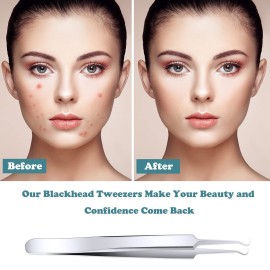 ANCIRS 6 Pack Acne Pimple Blackhead Remover Tweezers, Stainless Steel Acne Tweezers, Curved Pimple Tweezers Extractors Tool for Blackhead Blemish Removal-Silver Color ANCIRS 6 Pack Acne Pimple Blackhead Remover Tweezers, Stainless Steel Acne Tweezers, Curved Pimple Tweezers Extractors Tool for Blackhead Blemish Removal-Silver Color