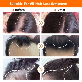 KIRUBRET Hair Growth Kit, Biotin Hair Growth Oil Serum, Hair Scalp Massager Helps absorb Hair Growth Oil Serum