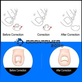 OdontoMed2011 Ingrown Toenail Corrector Stainless Steel Pedicure Tools for Curve Correct Ingrown Toenail Treatment, Tools for Ingrown Toenail Manicure Clipper Pedicure Fixer NL-CTR-01