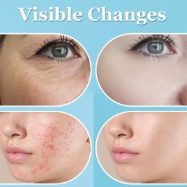 High Frequency Facial Wand - UUPAS Portable Handheld High Frequency Facial Machine with 6 Different Orange Tubes for Face/Hair/Body Home Use Device