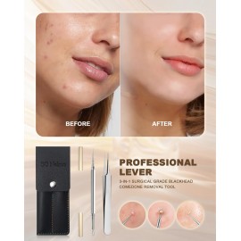 SGNEKOO Professional Facial Milia Removal Tool and Whitehead Extractor,Titanium Alloy Double Ended Needle and Steel Tweezers Kit,Blackhead,Blemish,Zit and Pimple Acne Remover Popper (Titanium Gold)