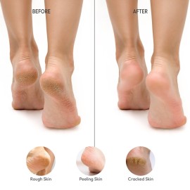 RED by Kiss Stainless Steel Ped Egg Foot File 2 in-1 Callus Remover for Dry and Wet Feet, Smooth Rough Skin, Include 2 Grit (Soft & Hard), Washable Foot Scrubber for Cracked Heels