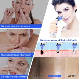 SACOTO Blackhead Remover Pore Vacuum, Face Suction Pore Cleaner, 5 Suction Power Electric Blackhead Extractor Tool, 4 Probes, Blackhead Suction Remover for Women & MenBlue