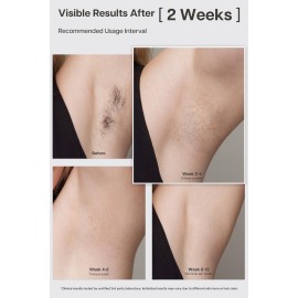 VRAIKO LYRA IPL Hair Removal Device, Laser Hair Removal for Women and Men, Sapphire Ice-Cooling Contact with Interchangeable Attachment Filters, More Skin-Friendly Long-Lasting & Painless Results VRAIKO LYRA IPL Hair Removal Device, Laser Hair Removal for Women and Men, Sapphire Ice-Cooling Contact with Interchangeable Attachment Filters, More Skin-Friendly Long-Lasting & Painless Results